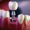 All on 4 dental implants Chennai  | Full mouth implants Chennai